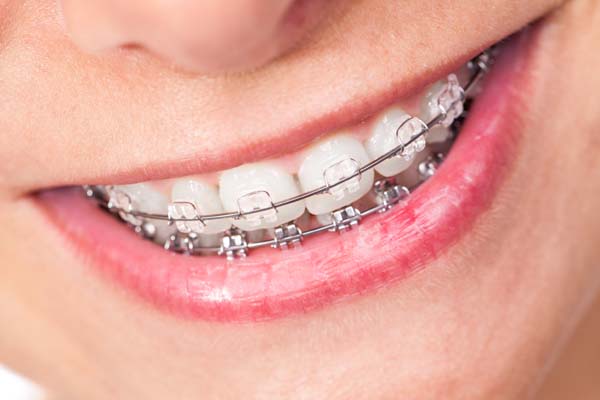 FAQs About Ceramic Braces For Kids