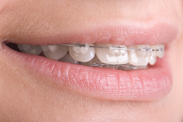 Why Clear Braces For Teens Are Recommended