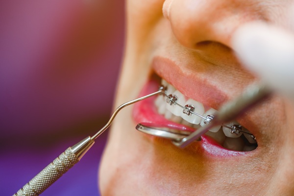 How Do Pitts    Braces Work?